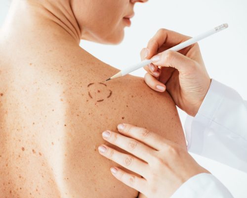cropped view of dermatologist applying marks on skin of naked woman with melanoma isolated on white